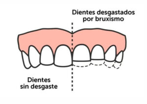 desgaste dientes